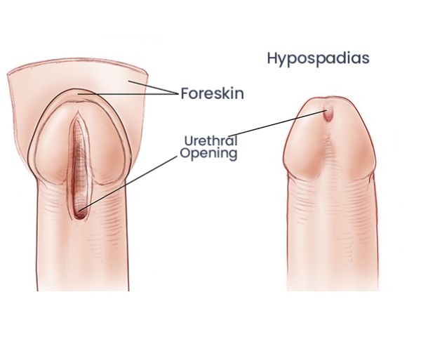 Dr. Aamer Iqbal | Expert Hypospadias Surgeon in Pune