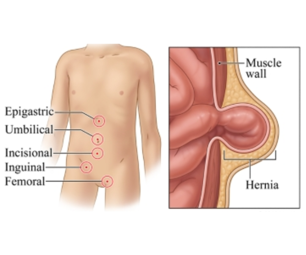 Dr. Aamer Iqbal | Paediatric Hernia Surgeon in Pune