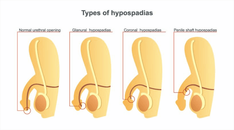 Types of hypospadias in children